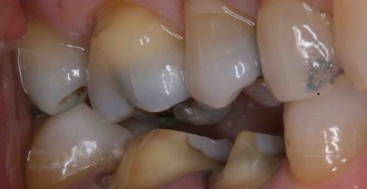 Determining the Right Amount of Occlusal Reduction