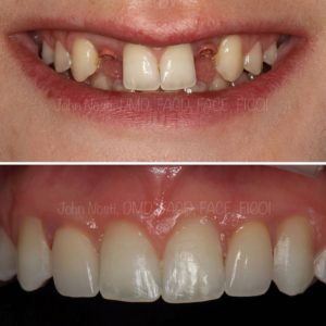 Missing Teeth Before and After