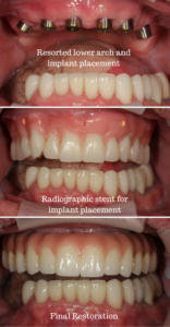 Cancer Survivor Case Study: Resorted lower arch and implant placement 