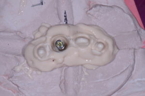 "Missing Tooth" case study custom impession coping
