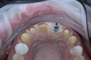 "Missing Tooth" case study occlusal