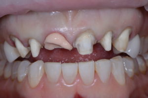 "Missing Tooth" case study retracted op 2