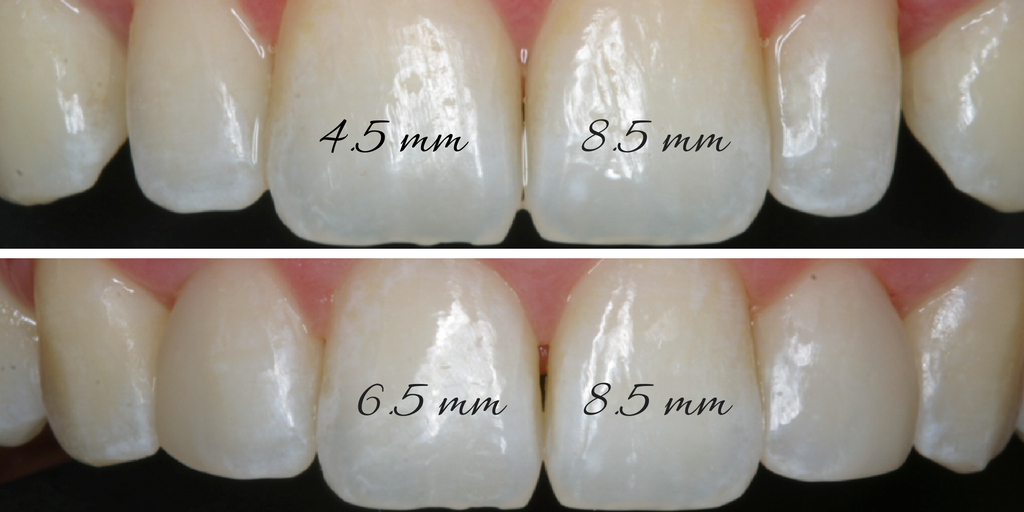 Improve Smile Design With an Easy Tooth Width Proportion Formula