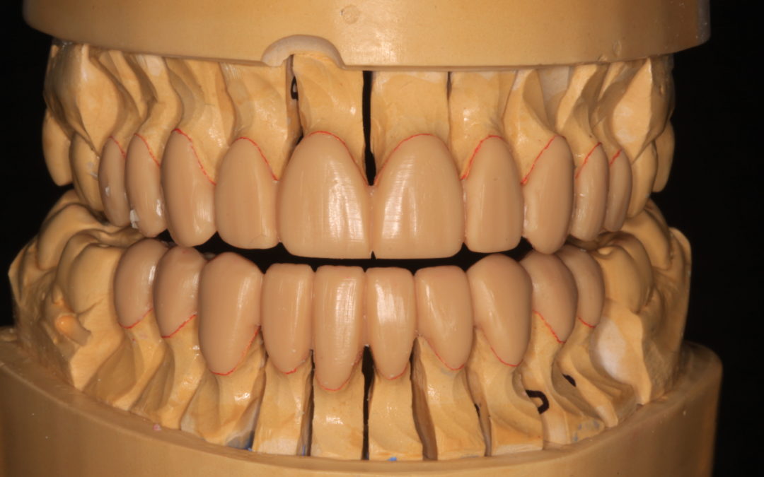 Taking Control of Vertical Dimension Changes in Dentistry: Control Bites Part 1