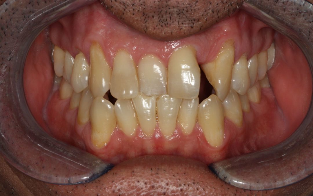 Utilizing Digital Dentistry to Predict Restorative Outcomes: Part 1